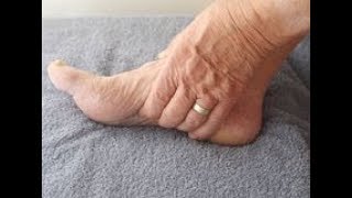 Prayer to Dissolve or Resolve Plantar Fibromatosis Fascitis [upl. by Acilgna]