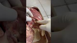 Autopsy removal of left lower lobe of lung and a large abscess cavity [upl. by Venice]