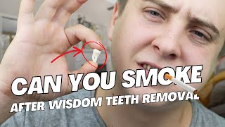 When Can You Smoke After Wisdom Teeth Removal [upl. by Asilegna]