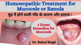 How To Treat Mucocele होंठ की गाँठ का इलाज और कारण Homeopathic Medicine for Oral Mucocele amp Ranula [upl. by Laud]