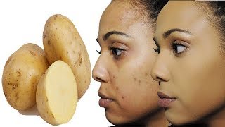 आलू से चेहरे के दाग धब्बे हटाये  Remove Black Heads and Dark Spots  Potato Face Pack [upl. by Naujuj]