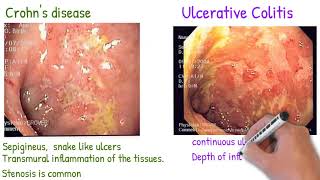 Crohns disease vs Ulcerative Colitis made simply [upl. by Mccurdy708]