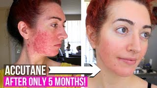 Accutane Side Effects  Mental Health Questions  Month 5 Update  Jess Bunty [upl. by Komara]