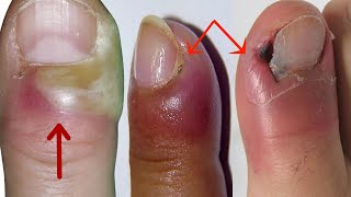 How to Treat Paronychia at Home  Home Treatment for Paronychia Nail Infection [upl. by Namharludba300]