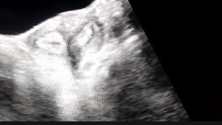 Bicornuate uterus on Ultrasound [upl. by Notac]