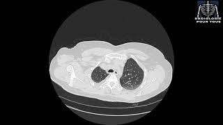 SCANNER THORACIQUE  Pleurésie bilatérale déjà traité pour TBK pulmonaire [upl. by Ahsiekim732]