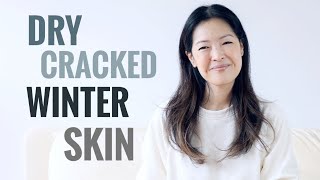 Tips For Treating Dry Cracked Winter Skin  Body [upl. by Adas]