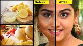 How to Remove Dark Spots in the Face Beauty Tips in Tamil [upl. by Jewelle811]