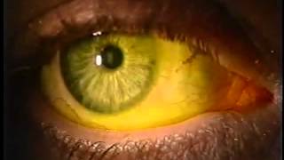 Instilling Fluorescein Dye in the Eye [upl. by Okika]