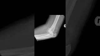 Posterior dislocation of the elbow with associated fracture of the coronoid process xray [upl. by Anaizit]