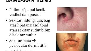 DERMATITIS PERIORAL  Materi Kedokteran  Dermatologi [upl. by Hearn641]