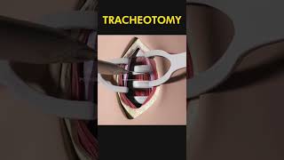 Tracheotomy 😷 explained [upl. by Dranyam]