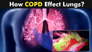 Chronic Obstructive Pulmonary Disease COPD  Symptoms Causes And Treatment UrduHindi [upl. by Hartmunn]