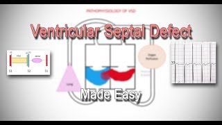 Ventricular Septal Defect VSD  Classification  Pathophysiology  Clinical Features  Made Easy [upl. by Awad706]