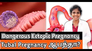 Ectopic Pregnancy ஆபத்துகள்  DrJagadeeswariRajalingam [upl. by Llereg]