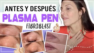 PLASMA PEN FIBROBLAST ANTES Y DESPUÉS  plasma pen  plasmapen plasmafibroblast CarolinaTV [upl. by Azelea749]