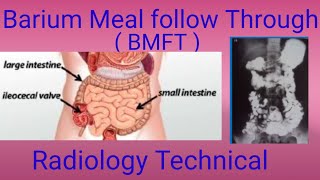 Barium Meal follow Through  BMFT Complete Study  By BL Kumawat [upl. by Runck616]