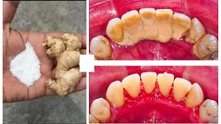 How to Remove Tartar from Teeth at home naturally  Natural Ways to Remove Tartar Buildup [upl. by Lellih925]