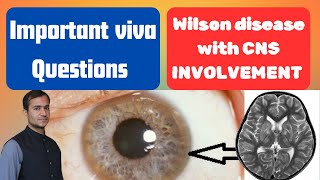 Wilson disease lecture  patient examination case presentation investigation and treatment Viva Qs [upl. by Eitten]