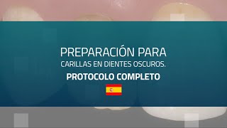 Técnica de preparación de carillas en dientes oscuros [upl. by Palua]