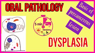 DYSPLASIA  Oral Pathology  easy explanation [upl. by Nyleuqcaj]