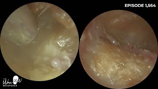 1564  Bilateral Rare Canal Cholesteotoma Patient Waiting 25 Years to be seen by ENT [upl. by Sybil]