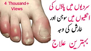 Hath Or Paon Ki Ungliyon Ki Sojan Ka Ilaj  Fingers Swelling In Winter  Remedy Clinic [upl. by Marja]