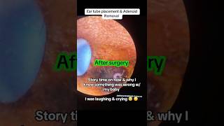 eartubesurgery eartubes adenoidectomy adenoidremoval adenoids eartubesurgery eartubes [upl. by Fosdick302]