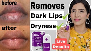 Derma co Kojic acid Lip Balm Review  Reduces Lips Pigmentation Dryness chappy lips darklips [upl. by Prestige34]