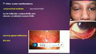 sarcoidosis and uveitis [upl. by Llertnod617]