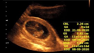 Inside 9 Weeks Pregnancy  Fetal Development and Ultrasound Insights [upl. by Ivonne]