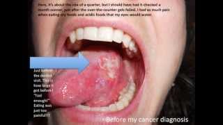 Young Person with Tongue Cancer Do you have it Wake the health up [upl. by Ateuqram]