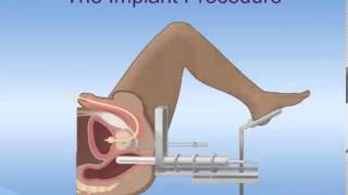 Brachytherapy for Prostate Cancer [upl. by Zined]