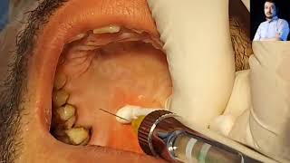 Local Anesthesia Greater Palatine Nerve Block Technique Maxillary anesthesia Techniques dentistry [upl. by Ferrick]