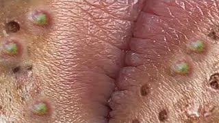 Big Cystic Acne Blackheads Extraction Blackheads amp Milia Whiteheads Removal Pimple Popping  3876 [upl. by Nirb852]