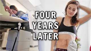 Four Years Later  No Regrets with Removing My Colon  Lets Talk IBD [upl. by Terena862]