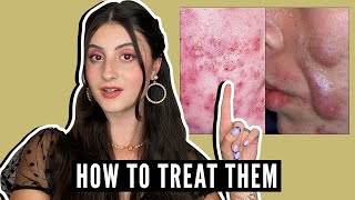 Types of ACNE and How to Treat Them [upl. by Lewanna]