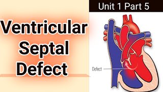 ventricular septal defect  vsd  pathophysiology symptoms and surgical treatment of VSD [upl. by Ahsel]