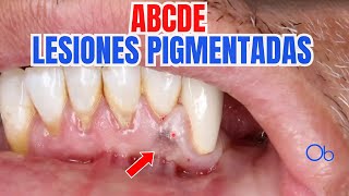 ABCDE de Lesiones pigmentadas en cavidad oral 👄 [upl. by Mcloughlin202]