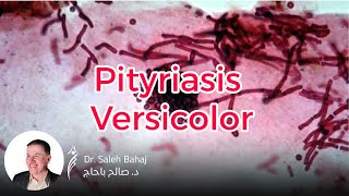 3 Pityriasis versicolor [upl. by Ahsauqal647]