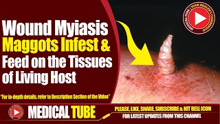 Wound Myiasis  Causes Symptoms Diagnosis And Treatment  Medical Tube [upl. by Azer]