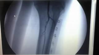 Angioplastia miembro inferior izquierdo [upl. by Attennaej]