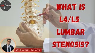 What is L4L5 Lumbar Stenosis [upl. by Jesselyn]