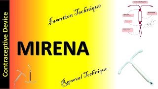 Mirena  Levonorgestrel Releasing Intrauterine System  Mirena Insertion and Removal Technique [upl. by Emersen]