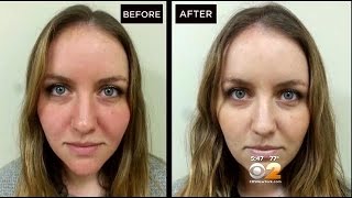 Dr Max Gomez Rosacea Treatment [upl. by Nydnarb]