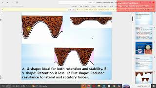 Retention of complete denture [upl. by Edak]