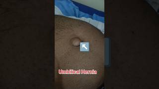 Umbilical Hernia Umbilical hernia showing video  pregnant ultrasound medical baby shorts usg [upl. by Indnahc]