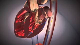 Cardiologie  TAVI Procedure EdwardsXT [upl. by Ynatsed]