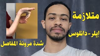 متلازمة ايرلز دانلوسمرونة المفاصل الزائدة اسباب، اعراض، تشخيص، علاج [upl. by Normi65]