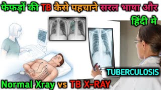 X RAY OF TUBERCULOSISTB  Normal vs TB Xray  Xray कैसें देखे । tb tuberculosis xray [upl. by Ducan]